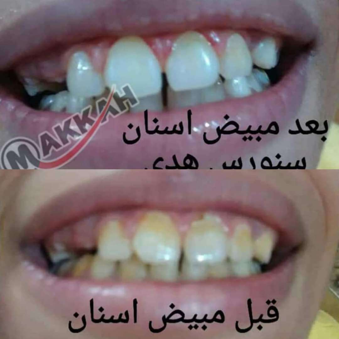 مبيض الاسنان مكه