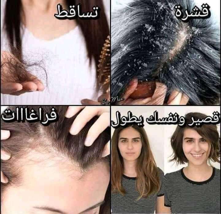 كريم فريش هير لعلاج القشرة