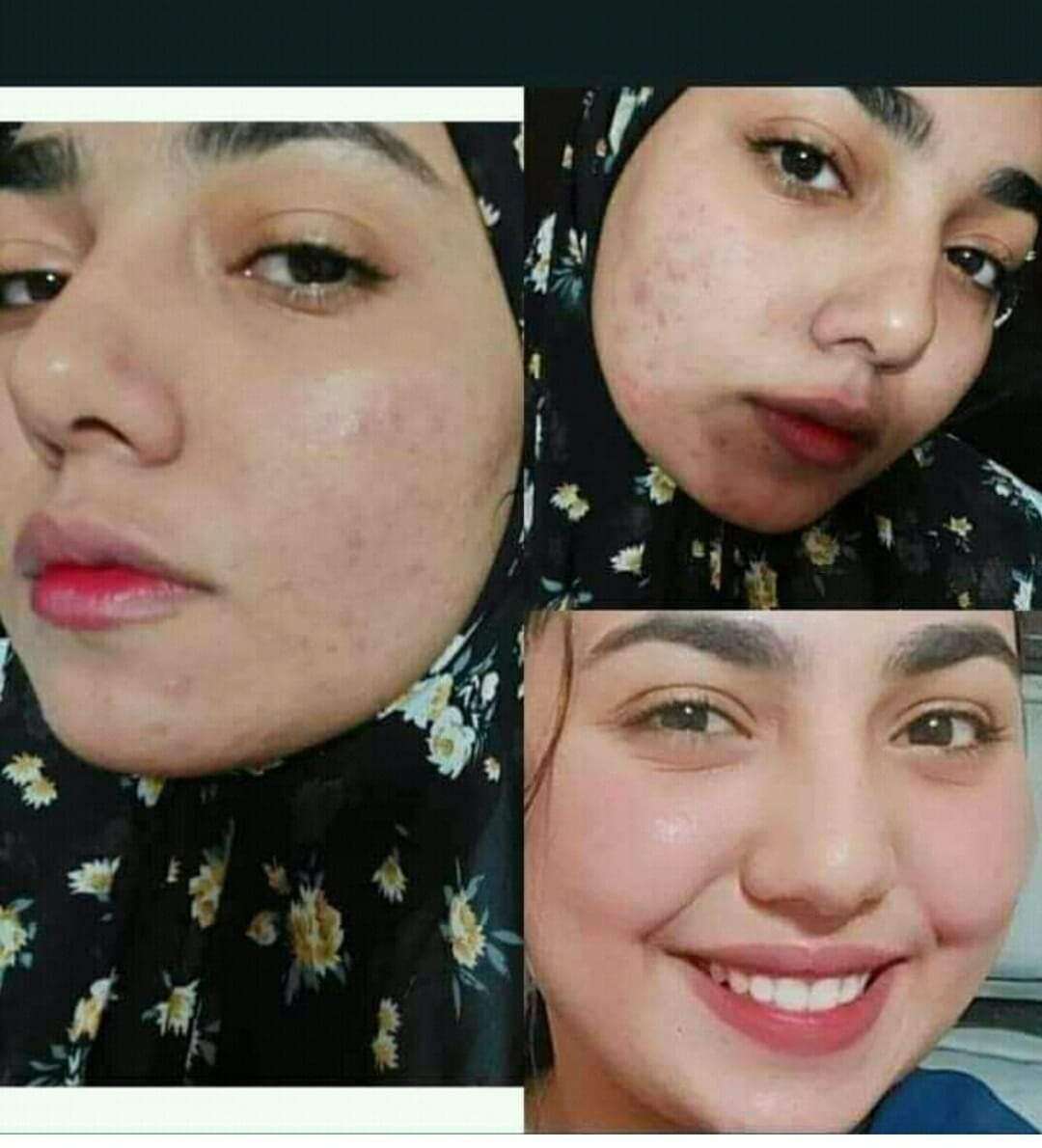 صابونة الفحم