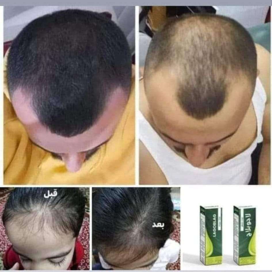 لاجو بلاج لإنبات الشعر ١٠٠ مل